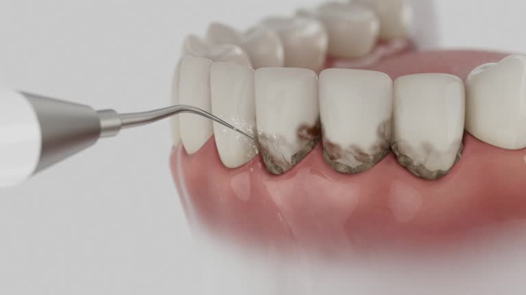 Trusted Invisalign Clear Aligners service in Mountain Lakes, NJ - Dentist Open Now